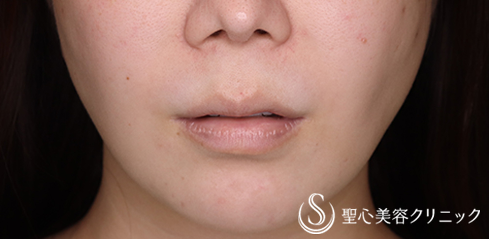 鼻下短縮術（リップリフト/人中短縮）_Before