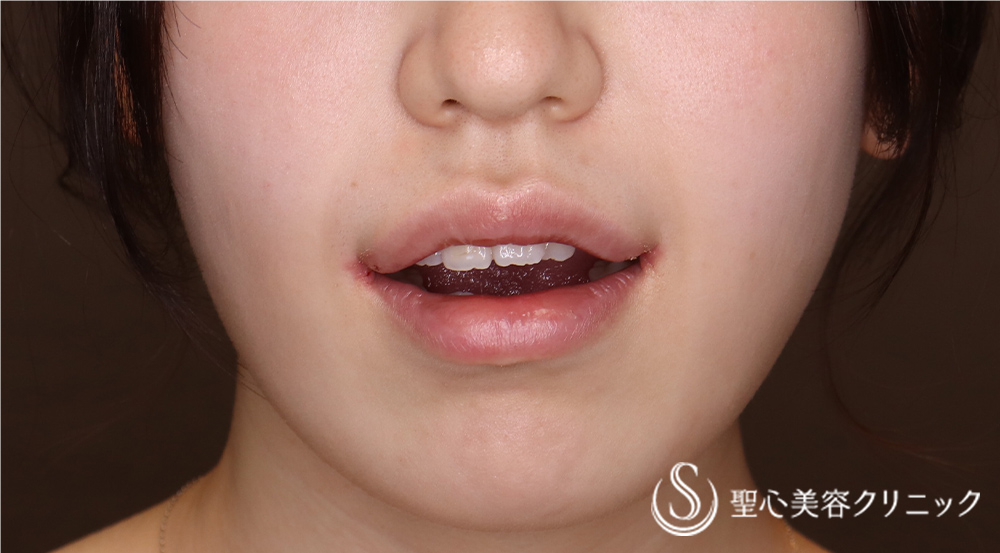 スマイルリップ_After