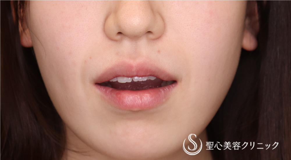 スマイルリップ_Before