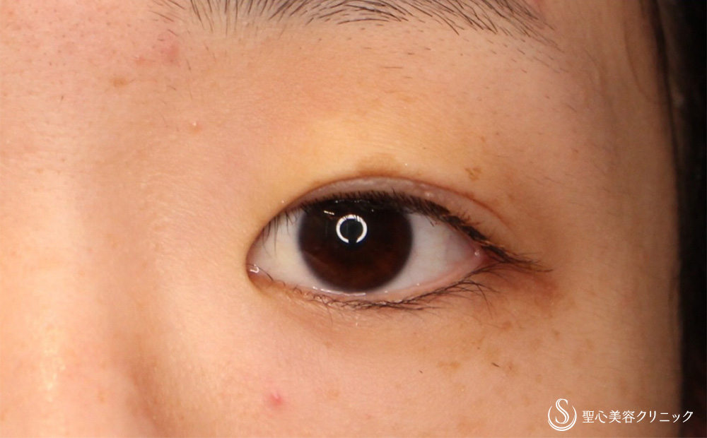 二重術（切開法）部分切開/全切開_After