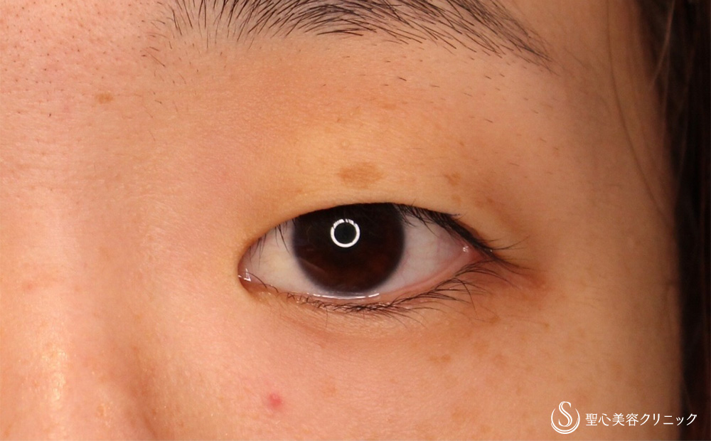 二重術（切開法）部分切開/全切開_Before