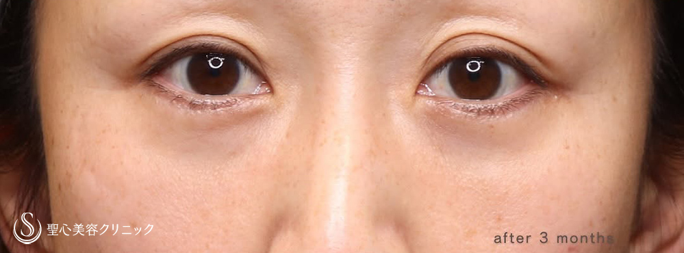 下眼瞼切開術/下眼瞼除皺術/ハムラ法_After