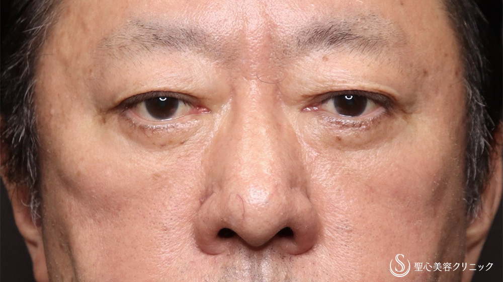 下眼瞼切開術/下眼瞼除皺術/ハムラ法＋目の下のたるみ取り_After