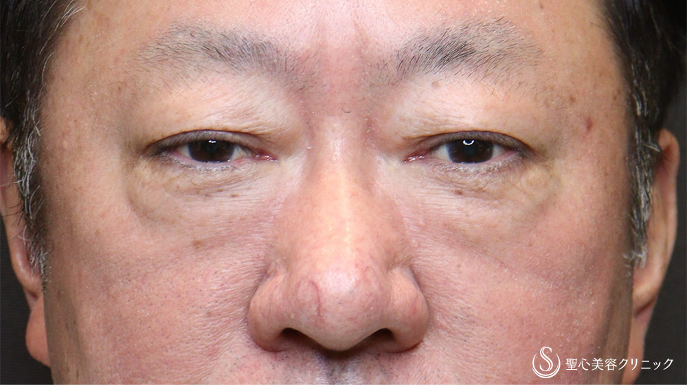 下眼瞼切開術/下眼瞼除皺術/ハムラ法＋目の下のたるみ取り_Before