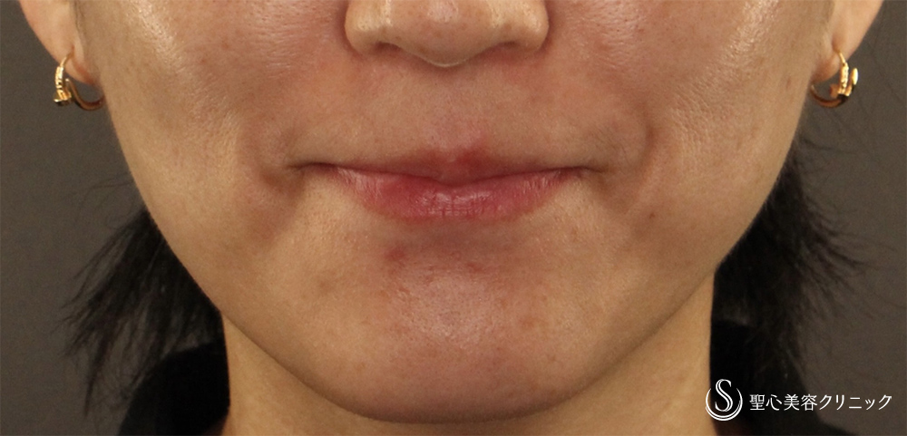 ボトックス注入_After