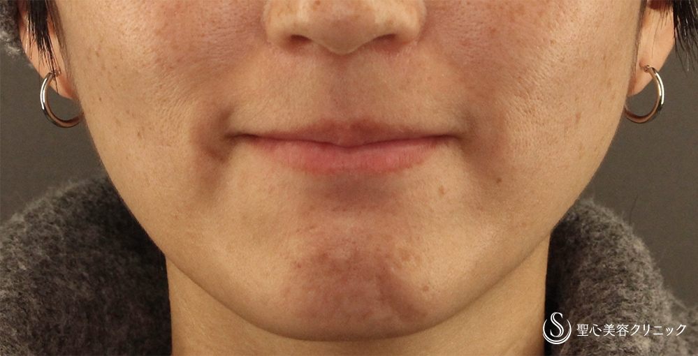 ボトックス注入_Before