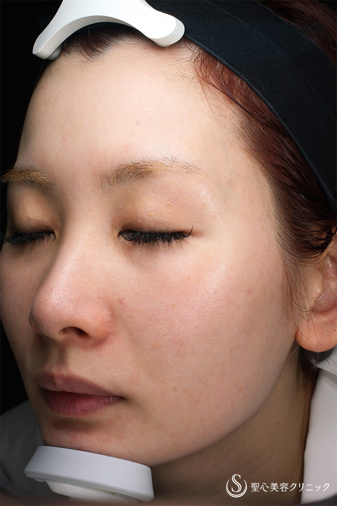 DENSITY（デンシティ）＜ドクター施術＞_After