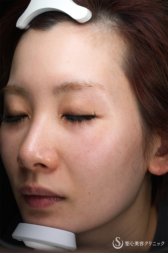 DENSITY（デンシティ）＜ドクター施術＞_Before