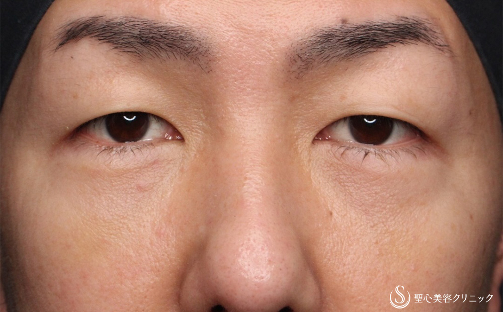 目の下の脂肪取り（経結膜下脱脂法）_After