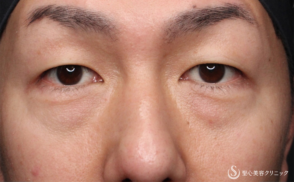 目の下の脂肪取り（経結膜下脱脂法）_Before