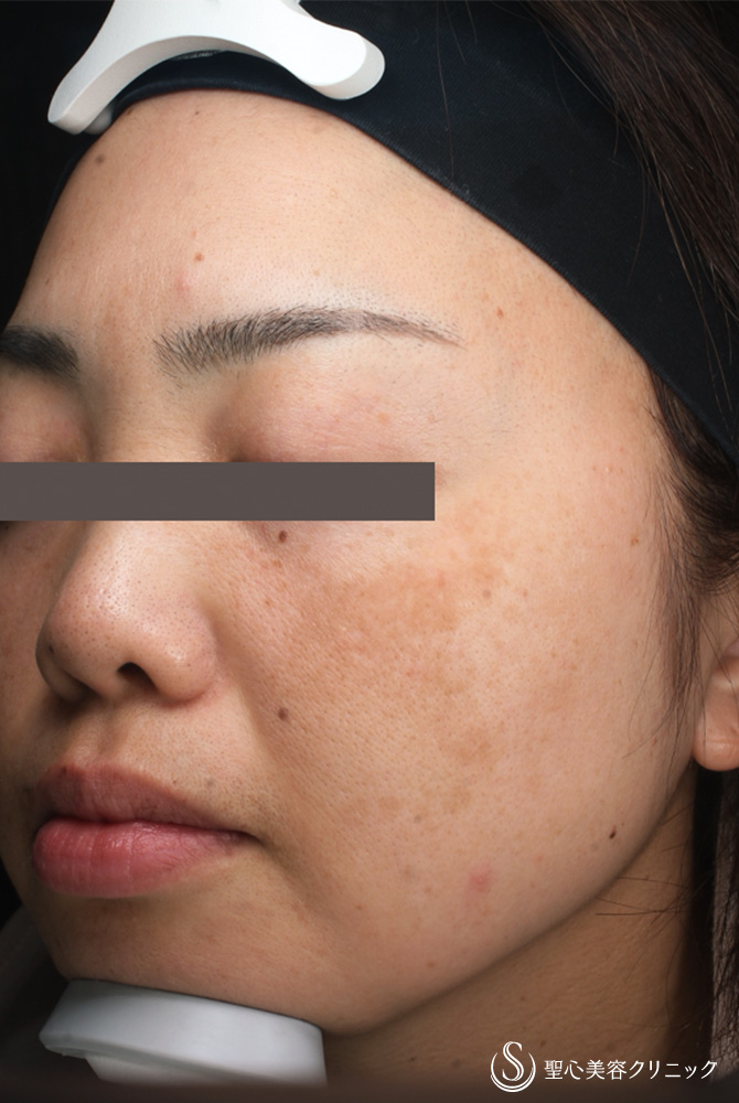 トラネキサム酸（トラネミック）_美白_Before