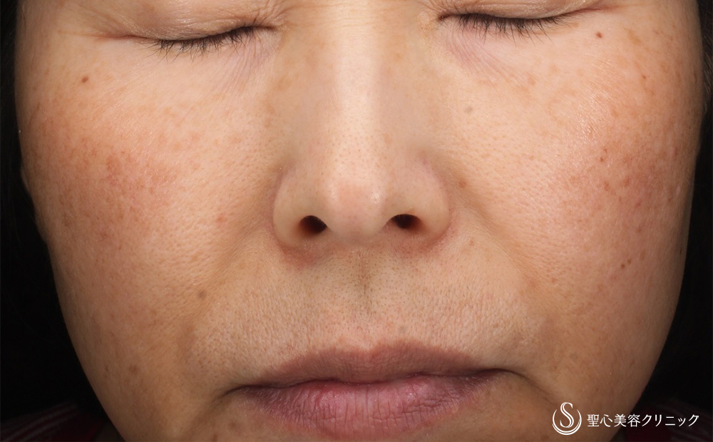 ピコレーザー_Before