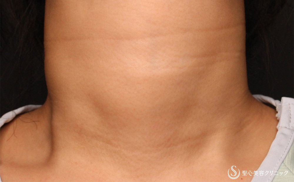 プレミアムPRP皮膚再生療法_After