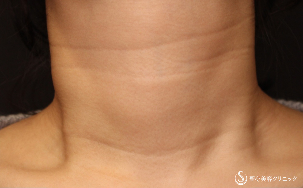 プレミアムPRP皮膚再生療法_Before