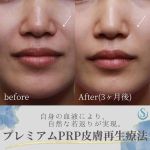 【自身の血液により、自然な若返りが実現】
⁡
当院人気のプレミアムPRP皮膚再生療法の
3ヶ月後の症例写真です。
20代の女性で、正面からはさほど法令線は目立ちませんが、小鼻の横あたりから口横にかけての凹みが少しあります。
このような場合には、貴族注射と同じように小鼻を持ち上げるように付け根からPRPを注入します。
プレミアムPRP皮膚再生療法は3ヶ月から6ヶ月かけて改善するため、3ヶ月の写真でもよくなっているのがわかります。
また、よく見るとまだ浅いですが、線のようなシワができており、皮膚の浅いところに注入することによって、ヒアルロン酸では改善が難しいシワを改善させることも可能です。
⁡
◼︎プレミアムPRP皮膚再生療法
⁡
【費用】325,600円(税込)
※注入量により変動あり
※クリーム麻酔代別途
⁡
【施術内容】
麻酔クリームおよびブロック麻酔後、
極細の鋭針や鈍針などで慎重に注入。
【成分】患者様自身の、PRP（多血小板血漿）に成長因子（ヒト線維芽細胞増殖因子）、塩化カルシウム。
【リスクや副作用】
浮腫、痛み、斑状出血、皮下結節、皮下色素沈着、アレルギー反応、異常増殖、悪性腫瘍の既
往がある場合腫瘍の増大

#聖心美容クリニック #聖心美容クリニック大宮院 #聖心 #美容 #美容クリニック #美容外科 #プレミアムprp皮膚再生療法 #プレミアムprp #再生療法 #prp #成長因子 #アンチエイジング #ほうれい線 #ほうれい線改善 #法令線 #法令線改善 #シワ #シワ改善