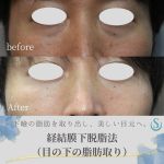 【下瞼を取り出し、美しい目元へ】

30代男性の切らないクマ取り(経結膜下脱脂術)の症例
です。
クマといっても厳密には目袋と言われる膨らみによりできる凹凸、影によるものです。
この膨らみの中身は眼窩脂肪という目の下にある脂肪です。若い方では元々多かったり、加齢とともに押し出されて
くることによって目立ってきます。
今回の手術では瞼の裏を切開を行なって、眼窩脂肪を取って減らしています。
眼窩脂肪をすべて取ってしまうという手術ではないため、
減量する加減がとても大切になります。
この手術は顔の表に傷跡が残らず、内出血も出にくく、
腫れも3、4日程度でだいぶ引いてくるため、ダウンタイムも短く、男性の方でも受けやすいという特徴があります。

目袋がなくなったことで、クマもなくなり、目元がすっきりとした印象になりました。
今回の症例もですが、膨らみによって埋もれていた涙袋が
手術をしたことでより目元がはっきりとするといった良さもあります。

◼︎経結膜下脱脂法

【費用】330,000円(税込)
【施術内容】結膜側に小切開を加え、適宜、眼窩脂肪を摘出。
【リスクや副作用】術後の腫れ、痛み、内出血、結膜浮腫、
くぼみや段差、小じわの出現

#聖心美容クリニック #聖心美容クリニック大宮院 #聖心 
#美容クリニック #美容外科 #美容 #整形 
#経結膜脱脂 #経結膜脱脂術 #経結膜脱脂法 #目の下のクマ #クマ #クマ取り #目の下のたるみ #目の下のたるみ取り #目の下の脂肪 #目の下のふくらみ