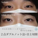 【目元を自然にくっきり見せて華やかな印象に】
⁡
元々一重で、自然な平行型の二重をご希望された症例写真です。
自然な二重を作ること自体は幅を狭めにすることで比較的どなたでも可能ではあります。
逆に幅を広くしていくと上にかぶさってくる皮膚が厚くなってくるため、ボテッとした不自然な二重となってしまいます。
ブジーという針金のようなもので、二重のシミュレーションをすることでどういった二重ができるかは確認ができます。
平行型か末広型の違いは二重の問題ではなく、眼の内側にある蒙古ヒダの程度によって決まってしまいます。
末広型とは蒙古ヒダによって、二重のラインが蒙古ヒダの裏側に隠れてしまう状態です。
そのため、蒙古ヒダのない白人種の場合は平行型となります。
シミュレーションにて二重を作ってみたときに、蒙古ヒダの程度によって基本的には平行型・末広型にどちらかに自然となります。
どちらかになりきらず、両方が混ざったものをミックス型と呼んだりしますが、自然の二重ではあまり見られないです。
今回の症例は、二重のシミュレーションでは末広型であったため、蒙古ヒダを弱める必要があり、目上切開を行いました。
写真は術後1ヶ月のもので、まだ傷の赤みが少し気になりますが、目上切開の傷跡は二重のラインに隠れるので、目立ちにくいです。
⁡
◼︎目上切開
⁡
【費用】275,000円(税込)
⁡
【施術内容】
蒙古襞を切開し希望の形に応じてZ形成やW形成などを行い、目頭の形状を変える。
⁡
【リスクや副作用】
内出血、腫れ、瘢痕（傷跡）の赤み、肥厚性瘢痕。
⁡
◼︎二重埋没 2点ダブルノット法
⁡
【費用】181,500円(税込)
⁡
【施術内容】
ブジーシミュレーションした希望のラインに沿って、数点で固定し、重瞼を作成する。
⁡
【リスクや副作用】
術後の腫れ、痛み、内出血、左右差、後戻り、シスト形成、異物感、ドライアイ症状、眼瞼痙攣。

#聖心美容クリニック #聖心美容クリニック大宮院 #聖心 
#美容クリニック #美容整形 #美容 #美容外科 
#二重埋没法 #二重埋没法 #埋没法 #埋没 #二重整形 #二重 
#2点ダブルノット法 #ダブルノット法 #目上切開 #目頭切開