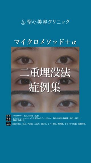 ・
マイクロメソッド＋α
二重埋没法症例集

デザイン別二重埋没法の症例をご紹介します👀

ぜひ最後までご覧ください❤️

—————————

🏥施術名
マイクロメソッド＋α（二重埋没法）

🌱施術内容
ブジーシミュレーションした希望のラインに沿って、特殊な専用の極細糸で数点で固定し、重瞼を作成する。

⚠️リスク・副作用
術後の腫れ、痛み、内出血、左右差、後戻り、シスト形成、異物感、ドライアイ症状、眼瞼痙攣。

💰費用
108,900円〜 225,500円（税込）

◇可愛さ×大人っぽさ🩷MIX型二重
👨‍⚕️担当医
六本木院医師 
綾部 奈々子（＠seishin_ayabe）

◇華やかさUP💓平行型二重（3点留め）
👨‍⚕️担当医
横浜院院長
佐々木 直美（＠seishin_sasaki）

◇ナチュラルに仕上げる✨末広型二重
👨‍⚕️担当医
六本木院 大阪院医師
星野 善允（＠seishin_hoshino）

—————————

症例紹介アカウント（ @seishin_beforeafter ）で他の症例もチェックしてみてくださいね💕

一人ひとりのご希望に寄り添う丁寧なカウンセリング🏥
あなたの悩みに最適なオンリーワンの施術を🌷
聖心美容クリニックの無料カウンセリングは下記からお気軽にご連絡ください✨

･+････+････+････+･･
📲WEB予約：プロフィールからリンクをクリック　@seishinbiyou
📞電話予約：0120-112-614
🍀LINE予約：「聖心美容クリニック」で検索
･+････+････+････+･･

#二重術
#二重埋没法
#マイクロメソッド+α
#MIX型二重
#平行型二重
#末広型二重

#美容クリニック 
#美容整形 
#美容医療 
#美容皮膚科 
#とことん真面目に美容医療 
#聖心美容クリニック
#聖心美容クリニック院
#聖心美容クリニック六本木院
#聖心美容クリニック横浜院
#聖心美容クリニック大阪院